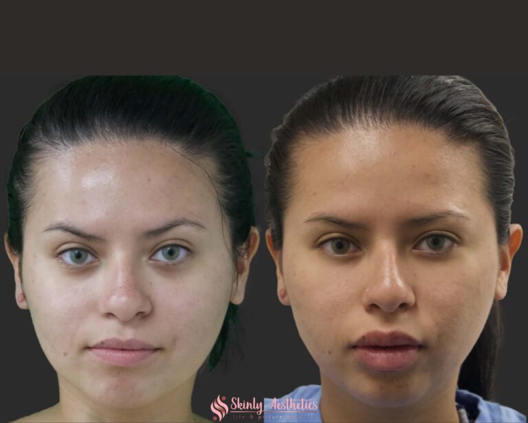 results after restylane lip filler injection