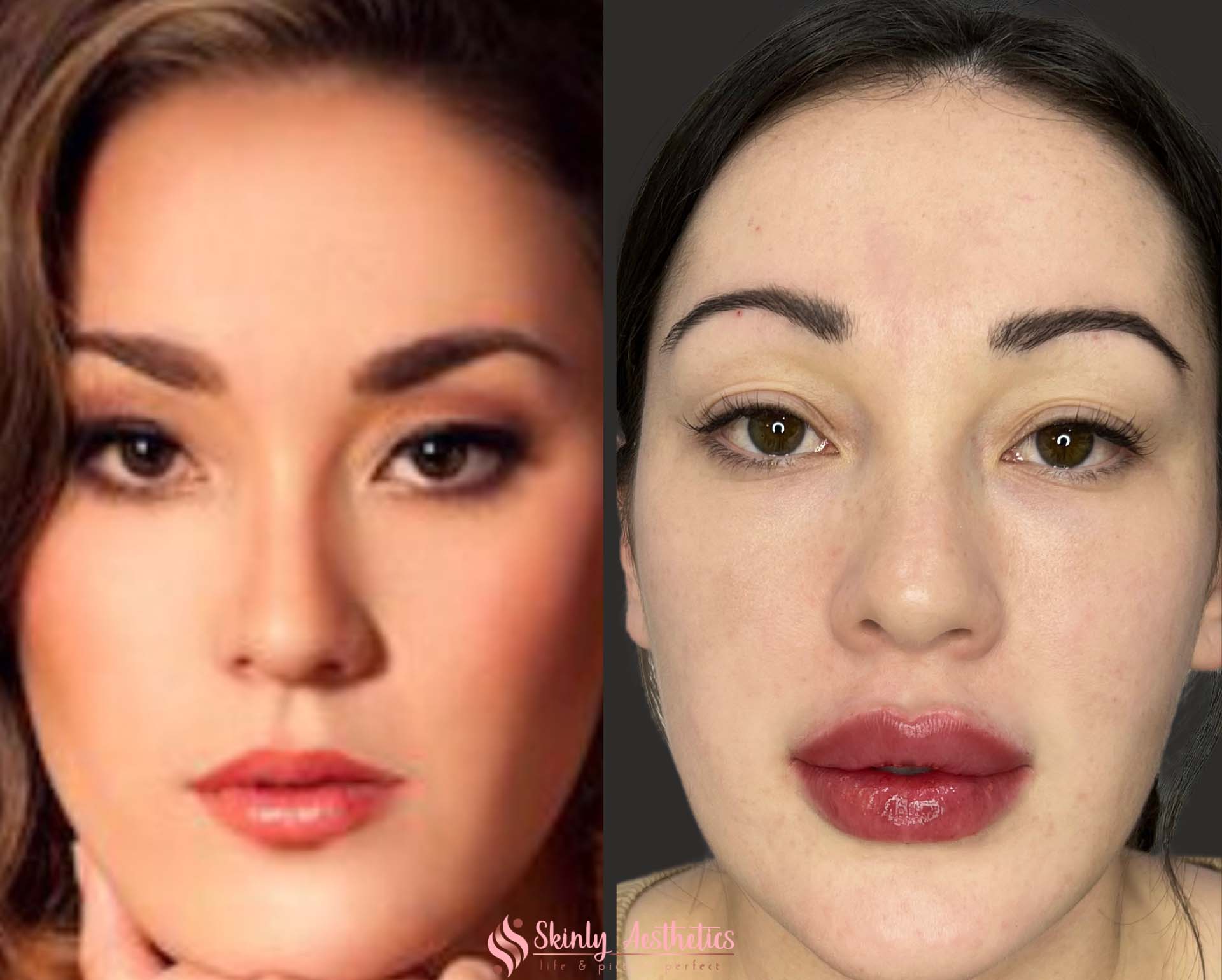results of russian doll lip technique with juvederm dermal filler