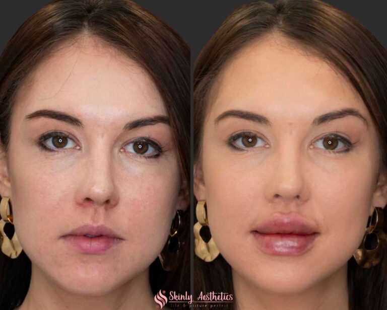 before and after results of Russian lip filler injection technique with Juvederm ultra
