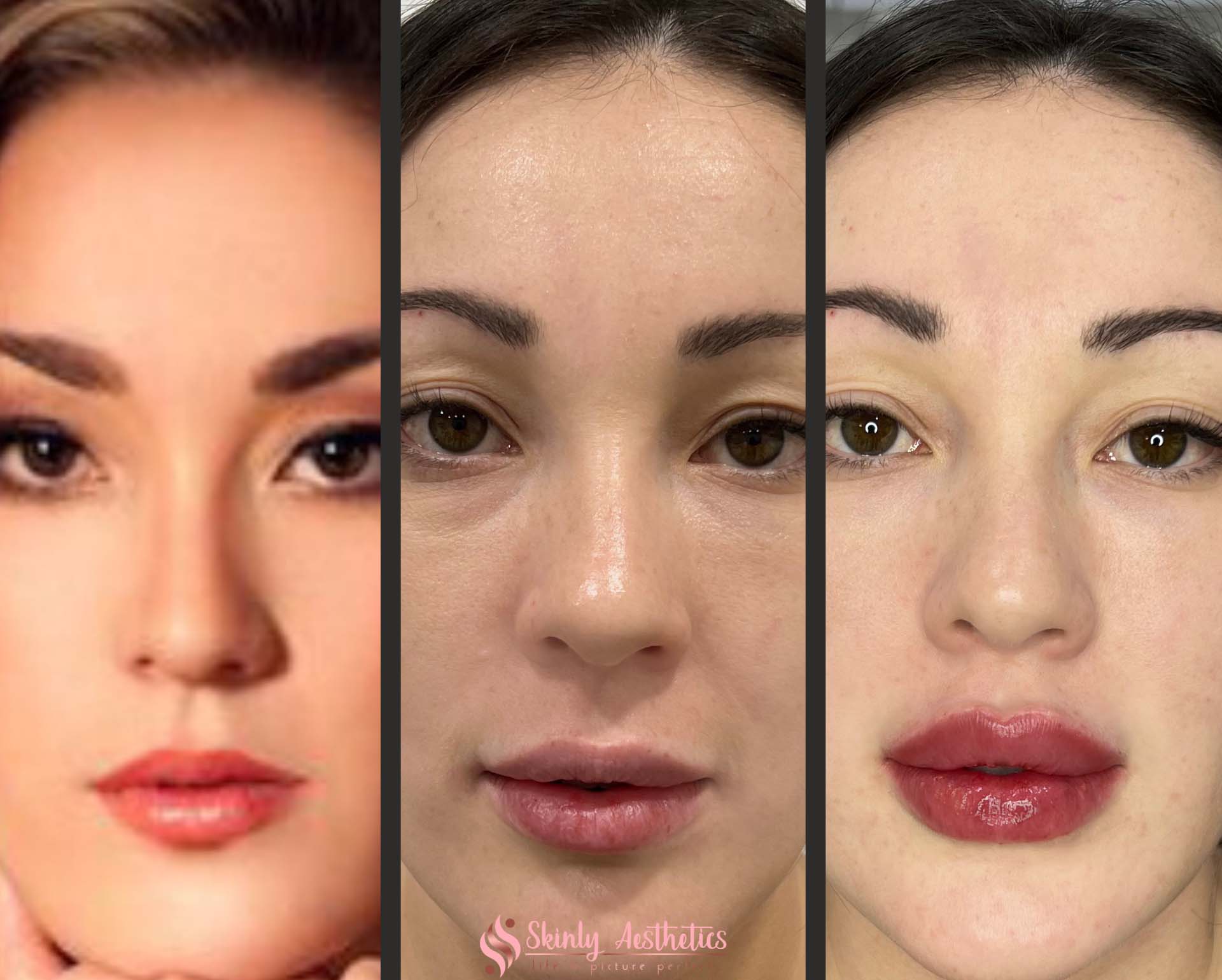 before and after russian lips filler injection with juvederm filler