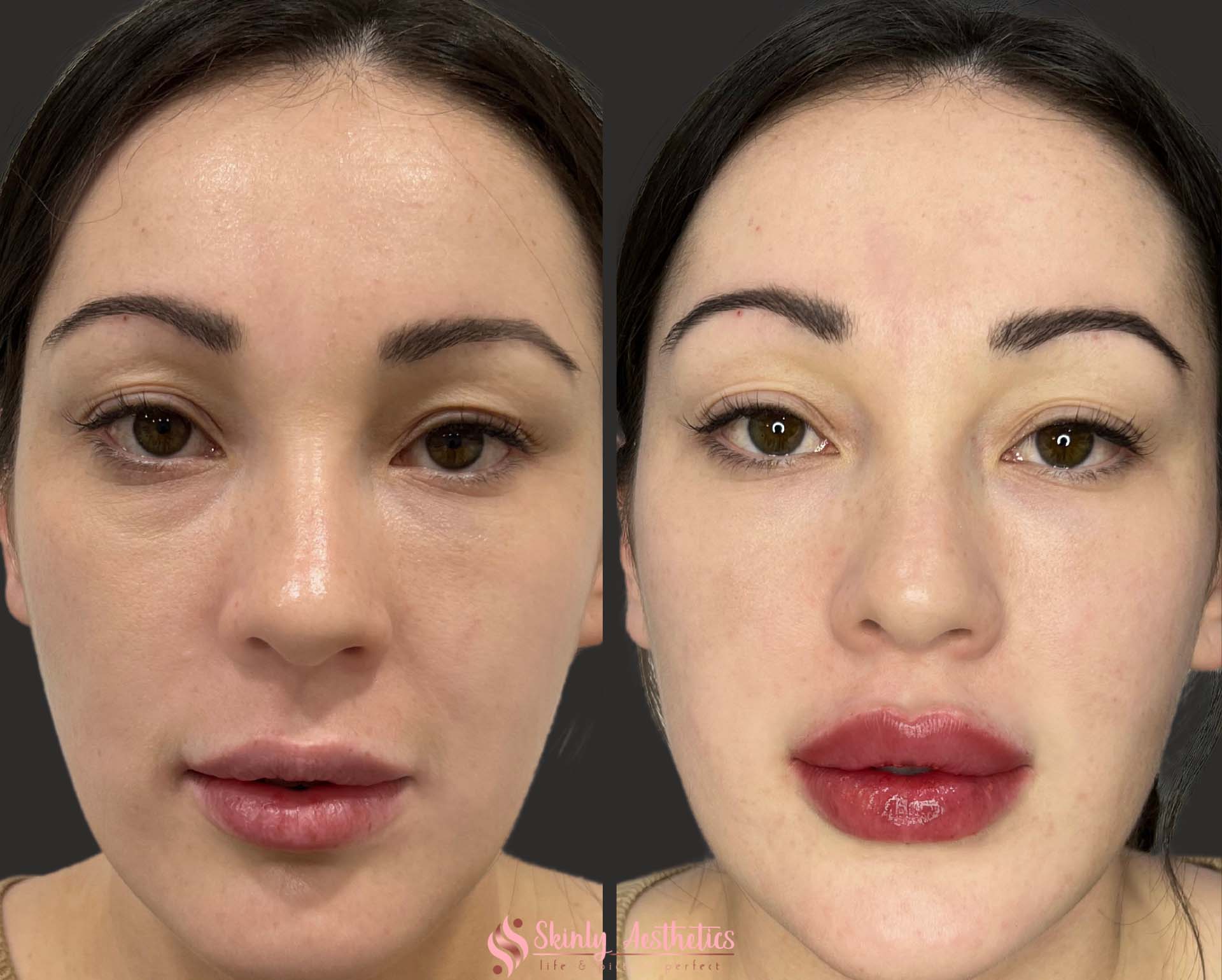 before and after results following the Russian lips filler technique with Juvederm Ultra