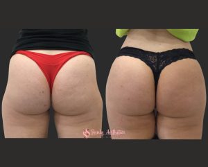 sculptra bbl