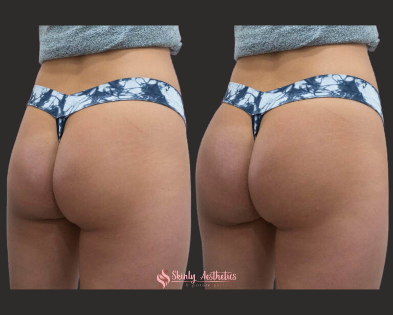 Sculptra butt augmentation before and after results