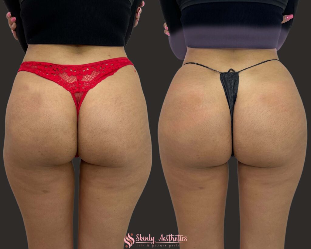 Non-surgical butt lift before and after results following 12 vials of Sculptra injections