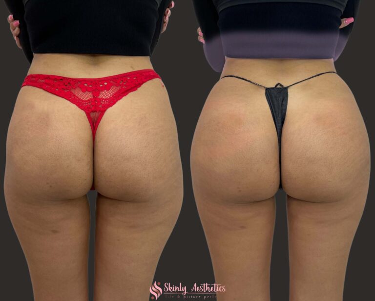 Sculptra Butt Lift - Benefits, Costs, Results & Procedure Steps