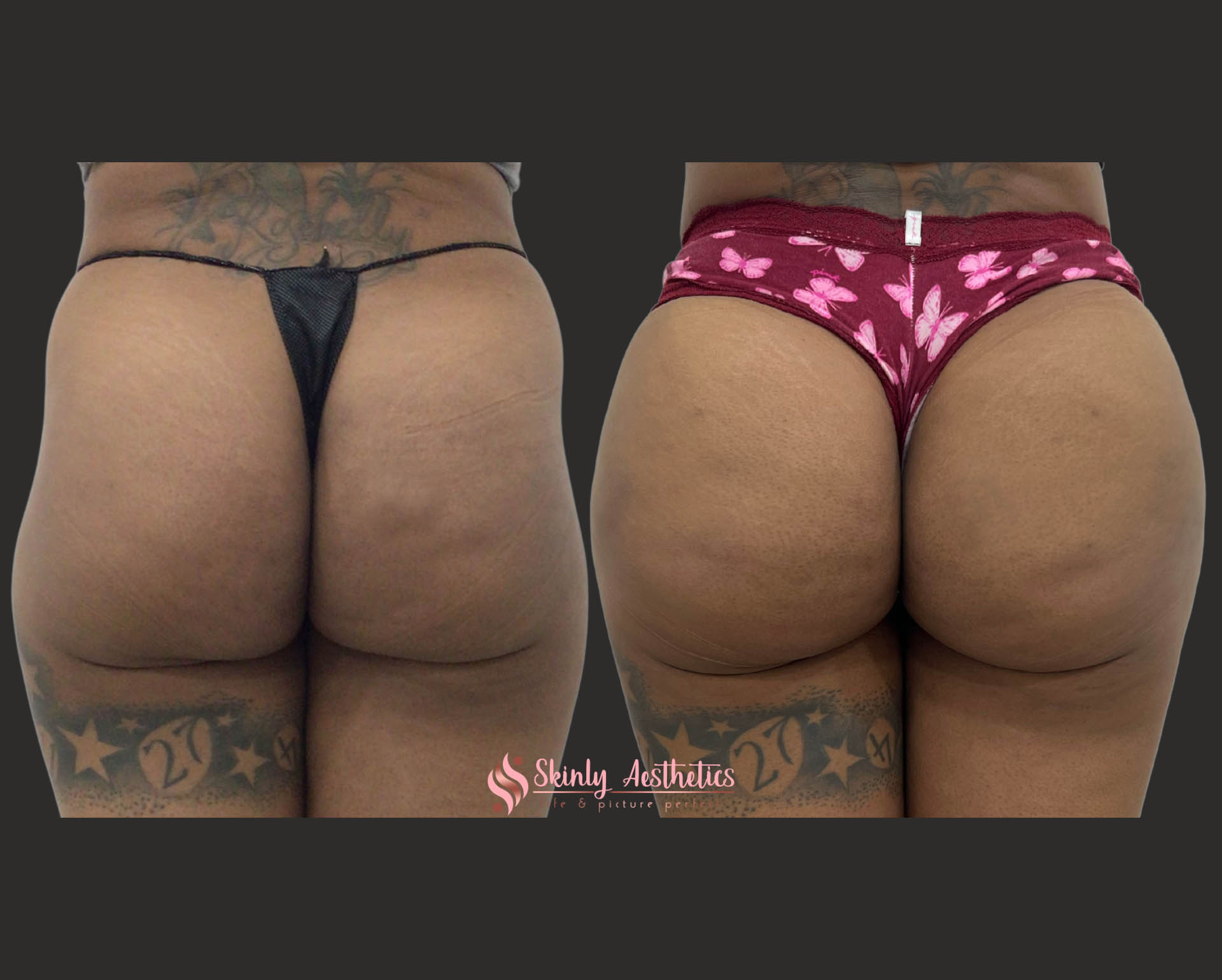 Before and after results following 12 vials of Sculptra butt injections