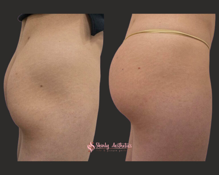 Before and after results following Sculptra butt lift treatment with 12 vials