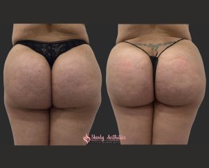 sculptra filler buttocks injections