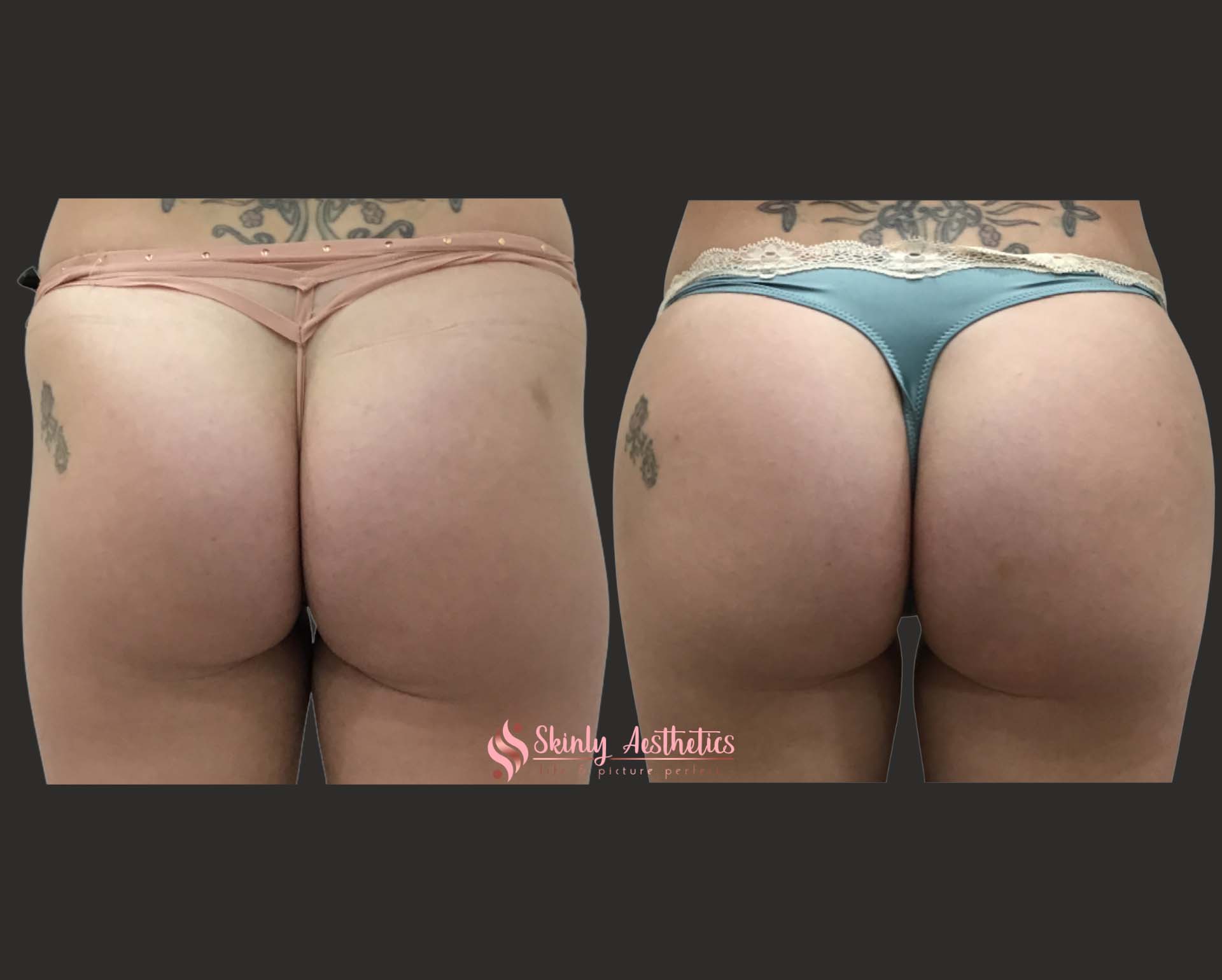 results after Sculptra filler hip dips injections