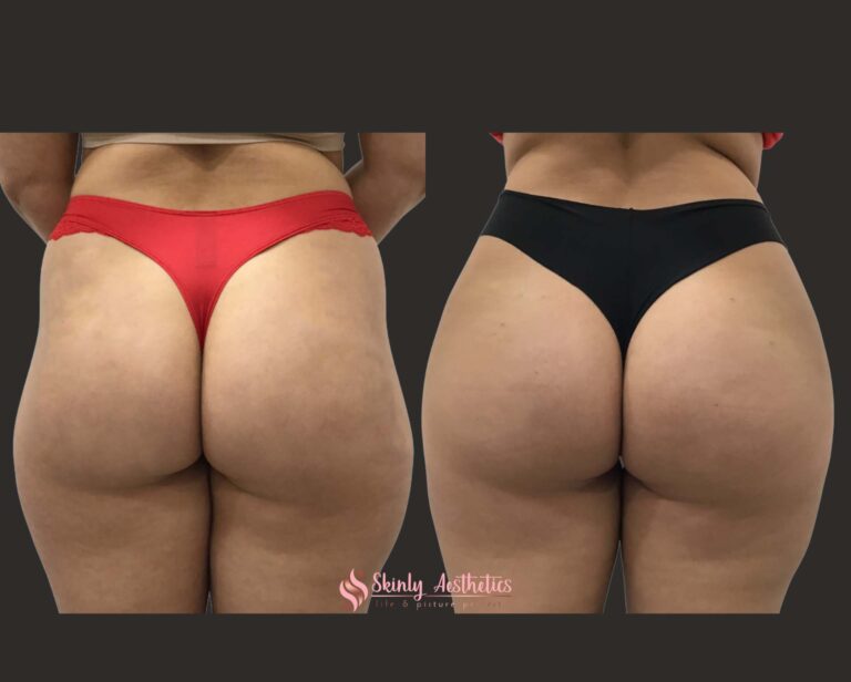 before and after results following Sculptra hip dips injections