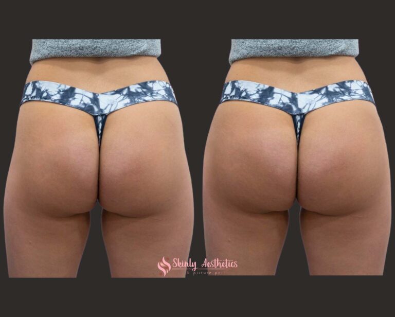 Sculptra hip dip fillers before and after