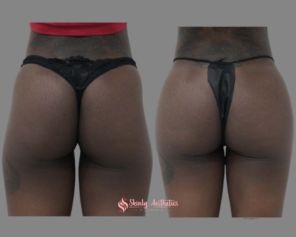 before and after of sculptra butt lift injections