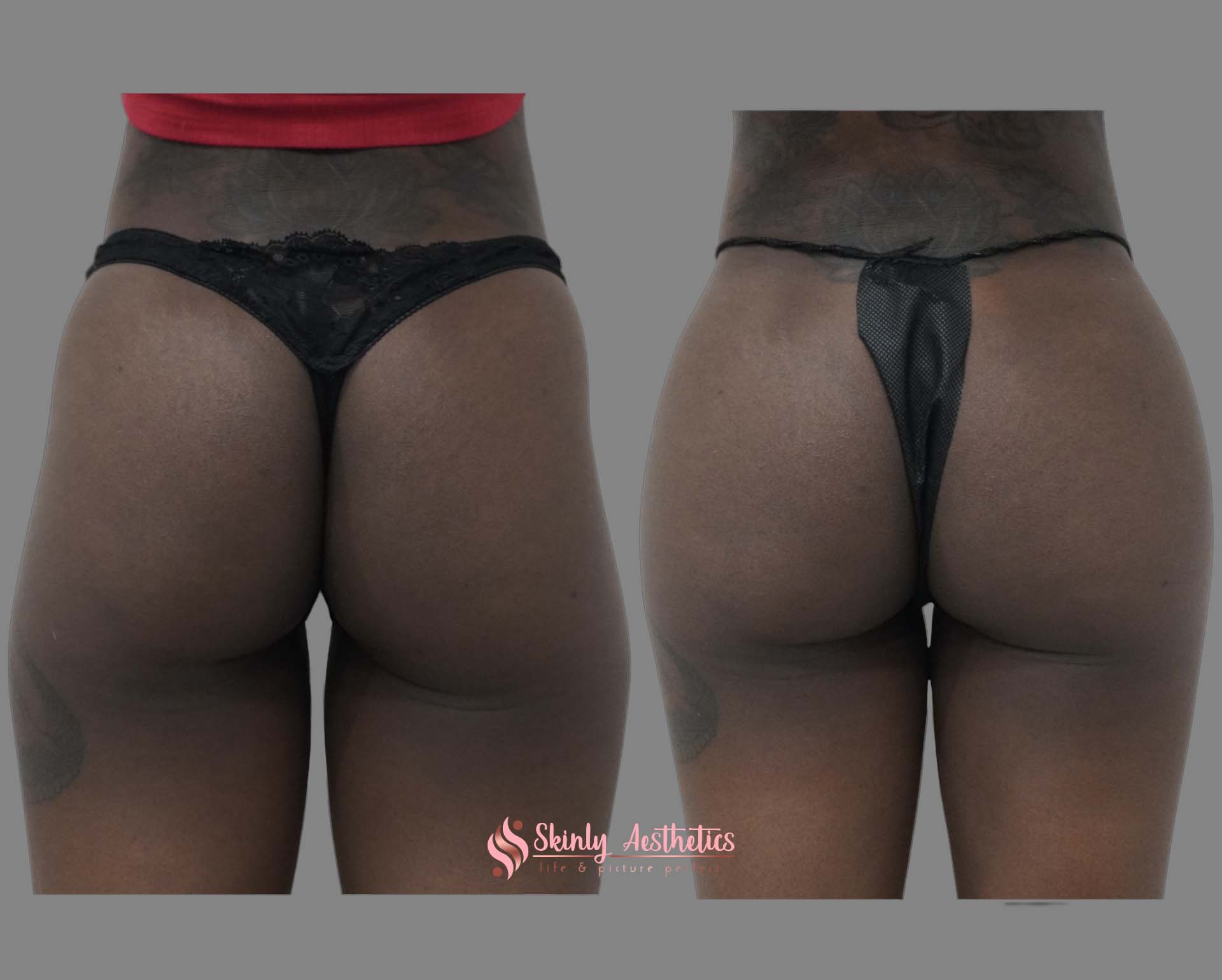 before and after results following 16 vials of Sculptra butt lift filler injections