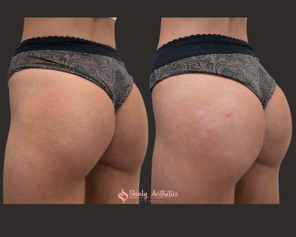 sculptra hips treatment before and after