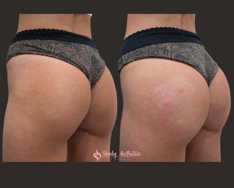 Sculptra hips treatment before and after results