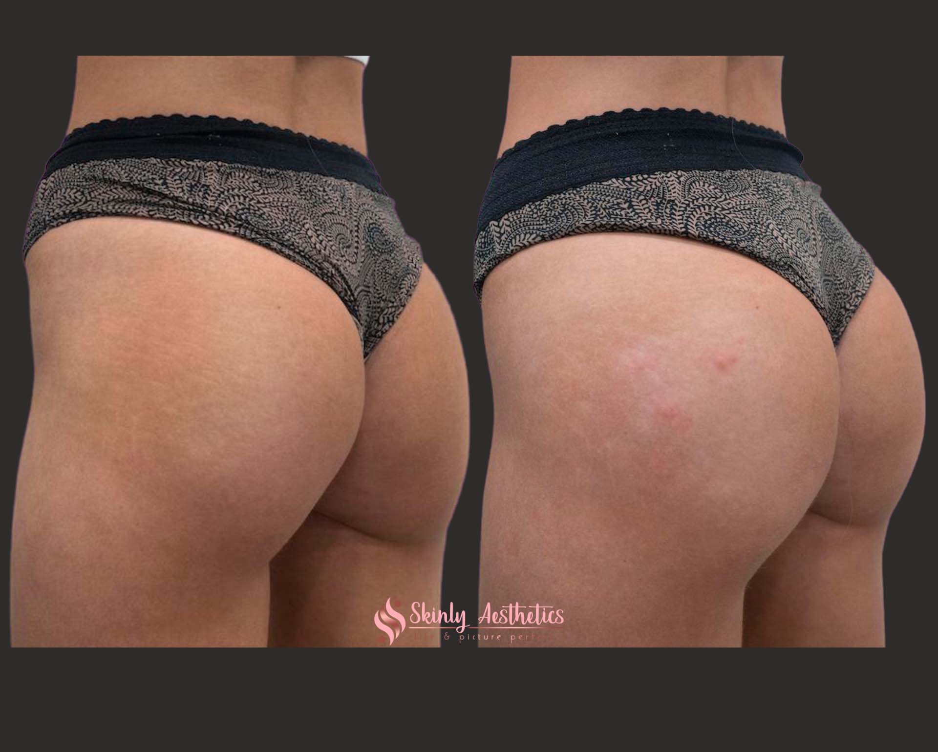 Sculptra hips treatment before and after results