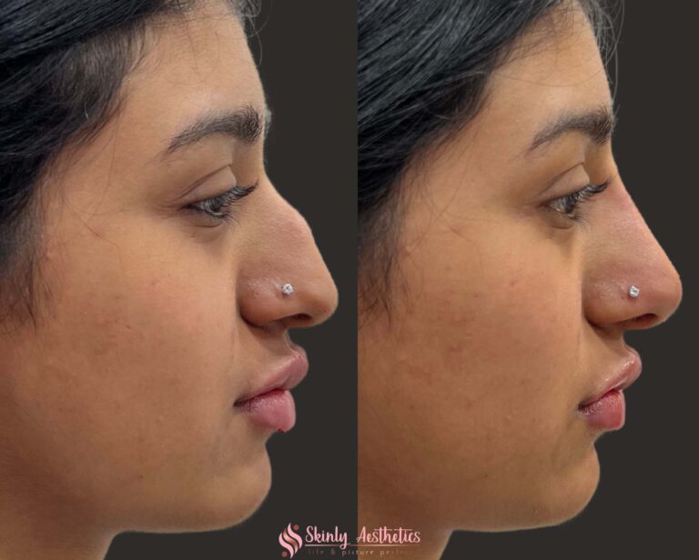 before and after results following liquid nose job with Juvederm Voluma to straighten the nose