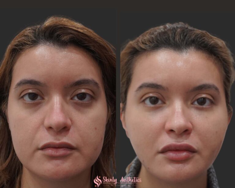before and after results of saggy cheek lifting with Juvederm Voluma filler