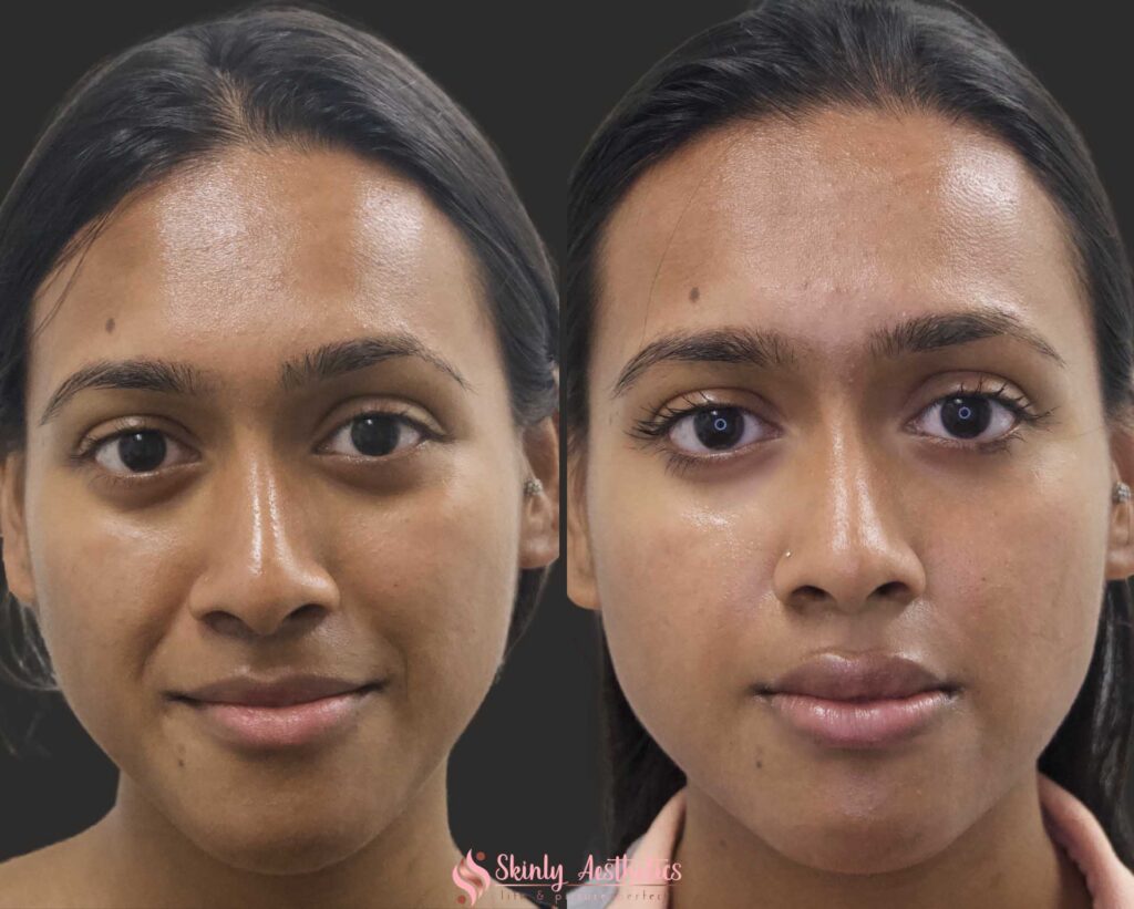 results after smoothing deep smile lines with Juvederm dermal filler