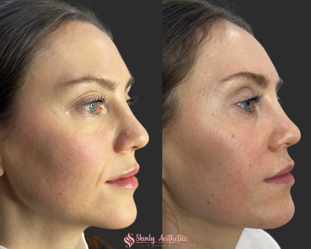 before and after results following Juvederm Ultra injections for smile lines