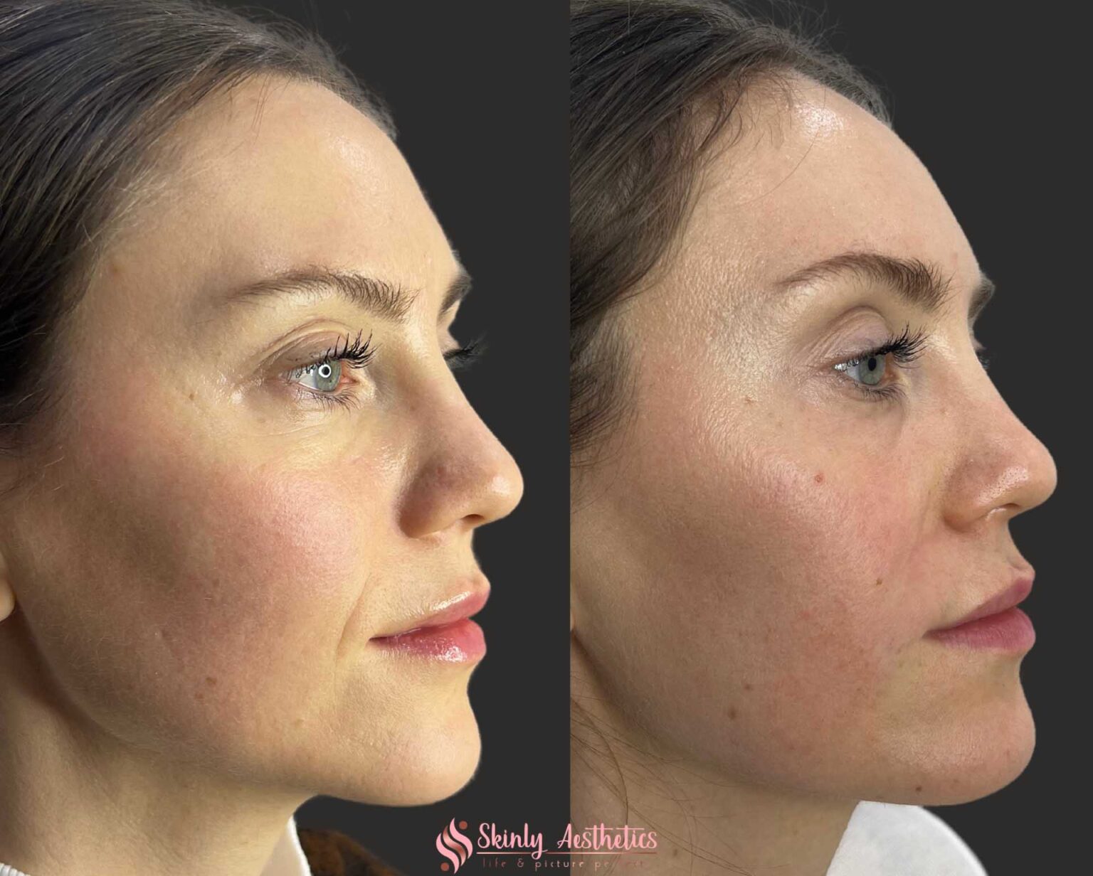 Smile Lift Treatment With Fillers - Benefits, Costs, Results ...