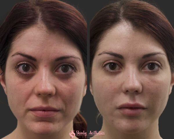 before and after laugh line injections with Juvederm Ultra