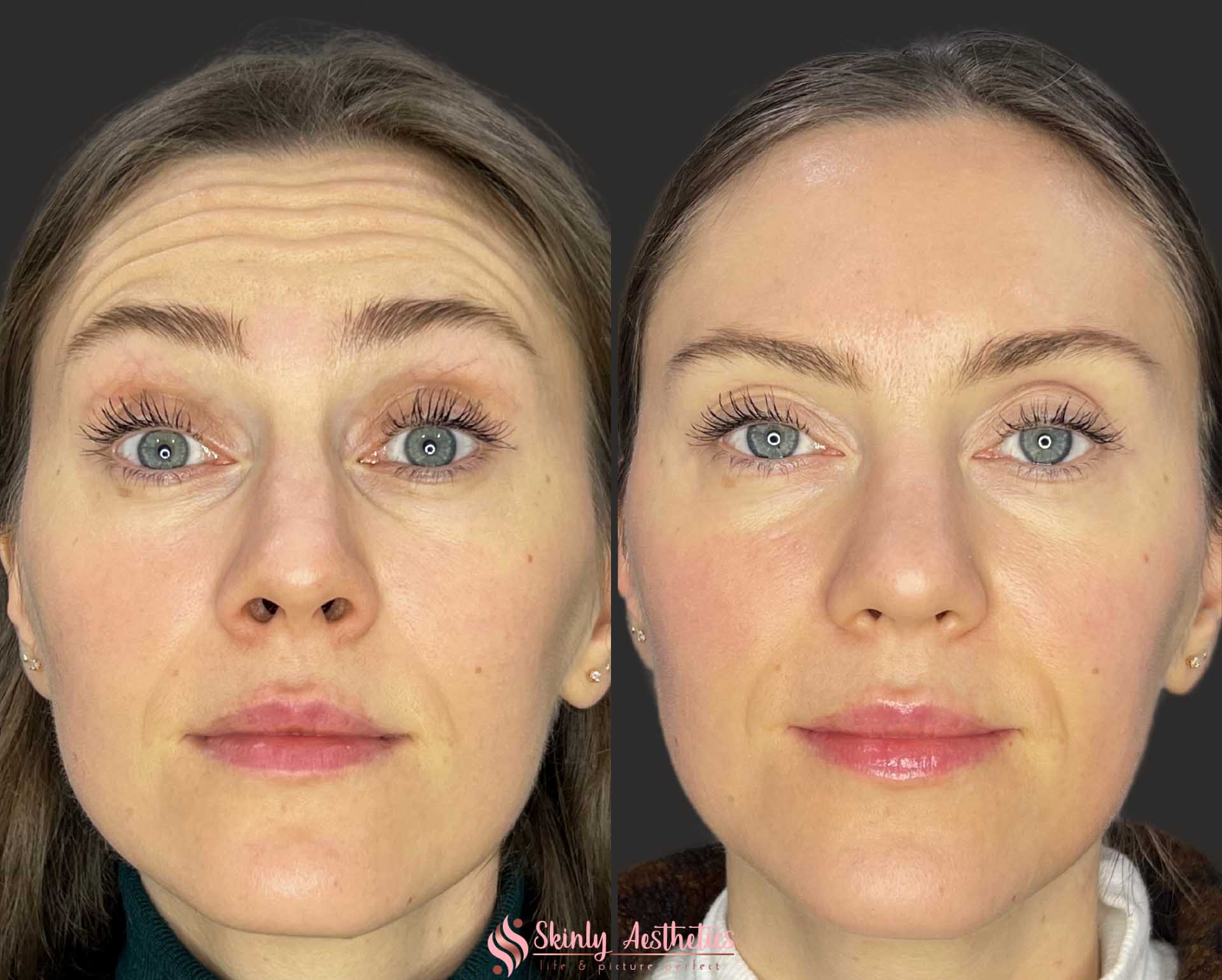 before and after results demonstrating effects of 20 units of Botox for horizontal forehead wrinkles