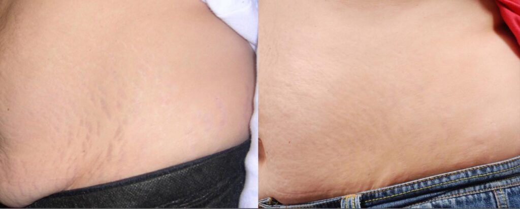 before and after results of stretch marks treated with a chemical peel