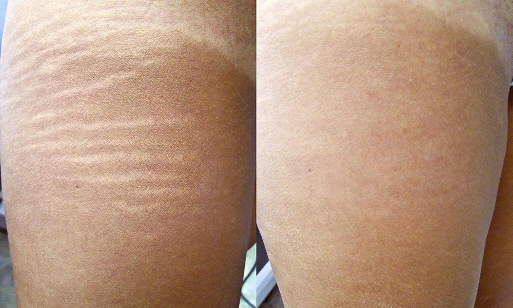before and after results of treating stretch marks with radiofrequency microneedling