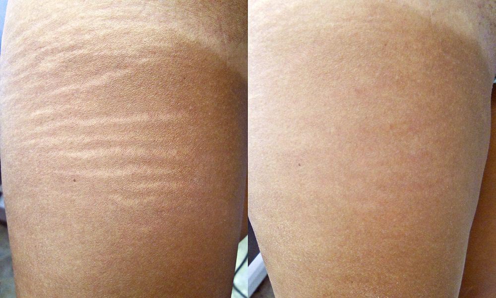 Skinly Aesthetics Stretch Marks Treatments Explained