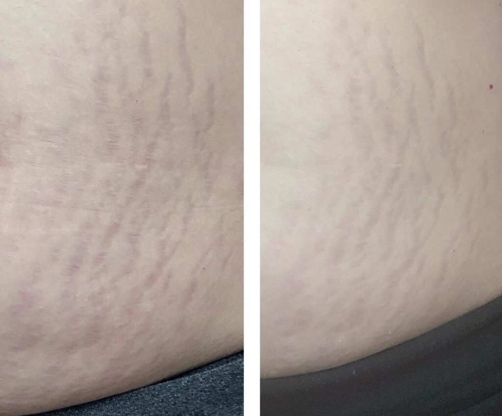 before and after results of stretch marks treated with topical retinol