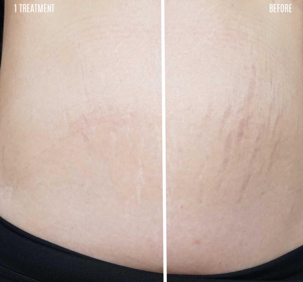 before and after results of stretch marks treated with silicone gel