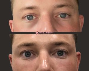 tear trough treatment with Juvederm Voluma