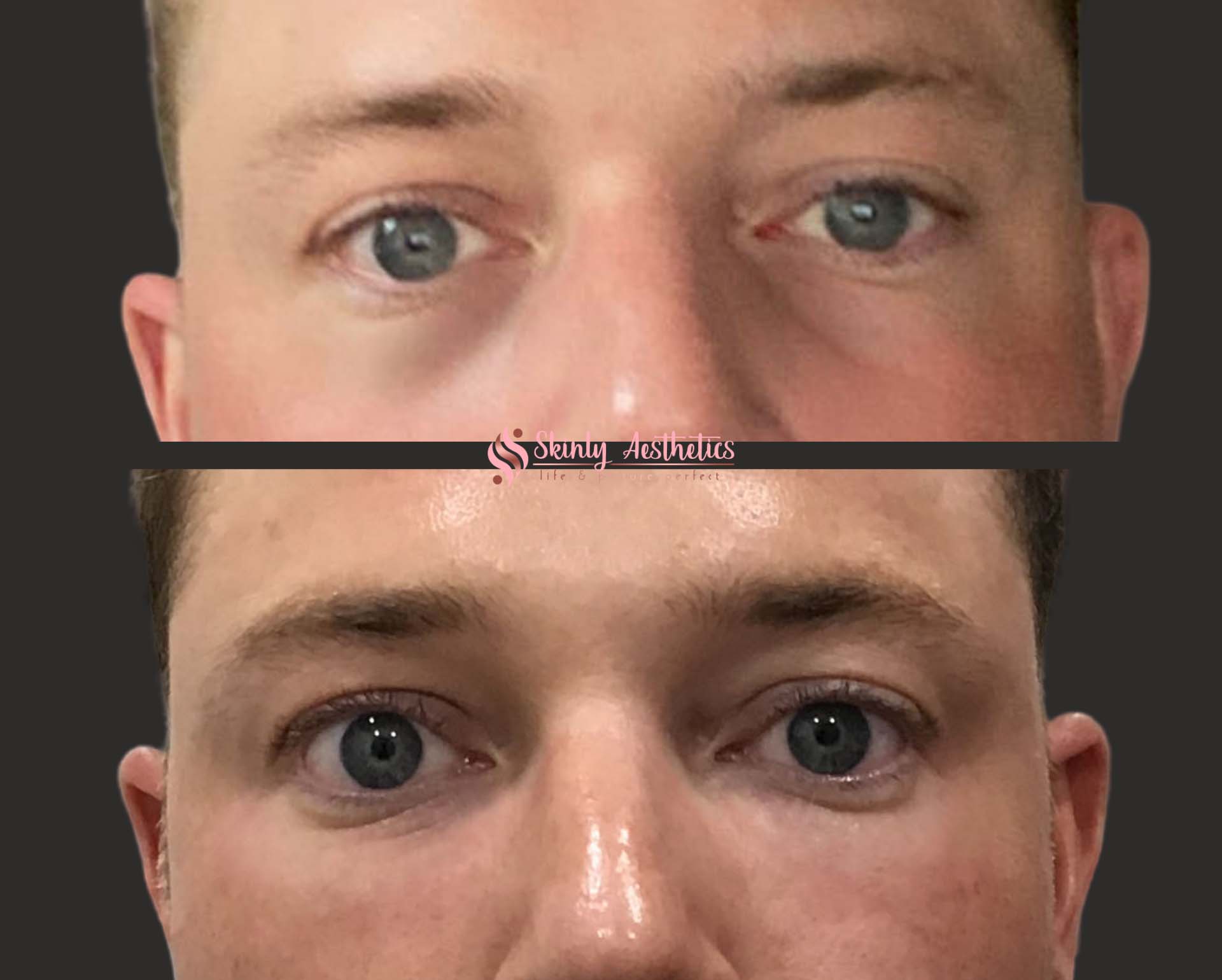 radiesse before and after under eyes