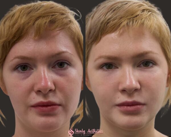 before and after results following under-eye bag treatment with Restylane filler