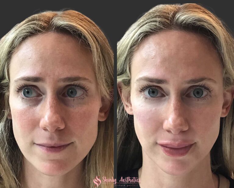 results after under eye circle treatment with Restylane filler