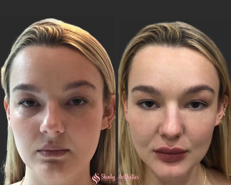 before and after results following under eye circles treatment with Juvederm filler