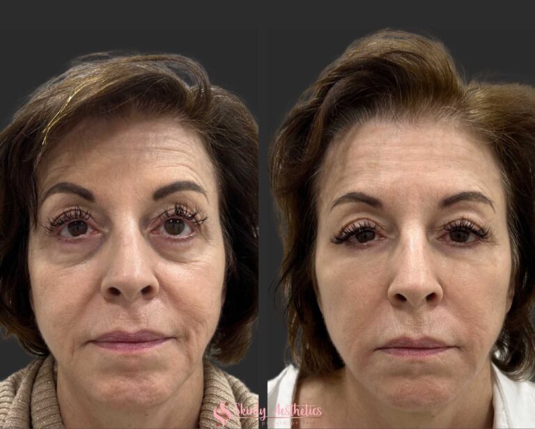 before and after results upon completion of under eye circles treatment with Juvederm filler