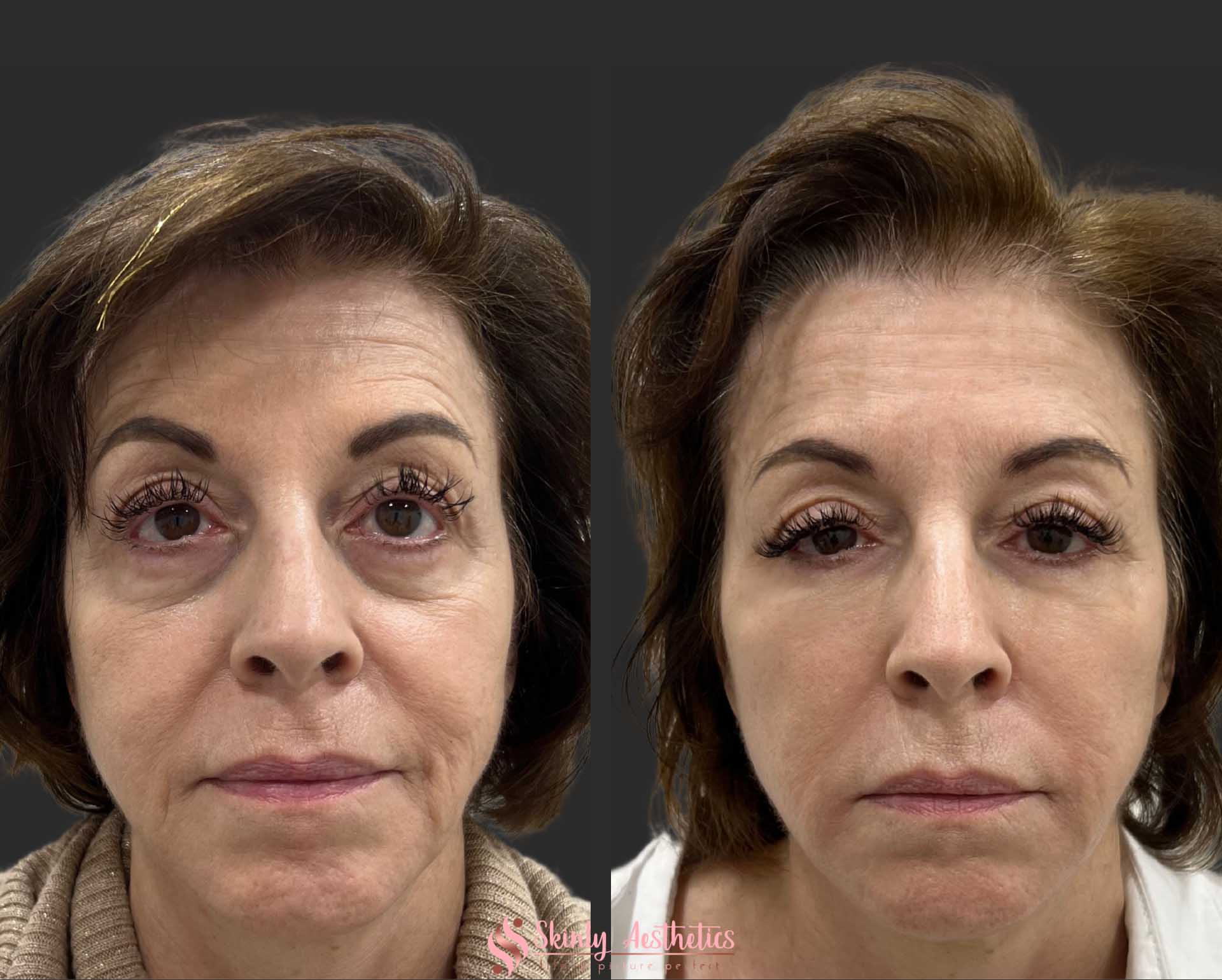 Under Eye Fillers Before & After Results at Skinly
