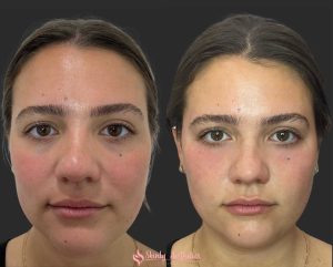 under eye dark circle treatment with Restylane dermal filler