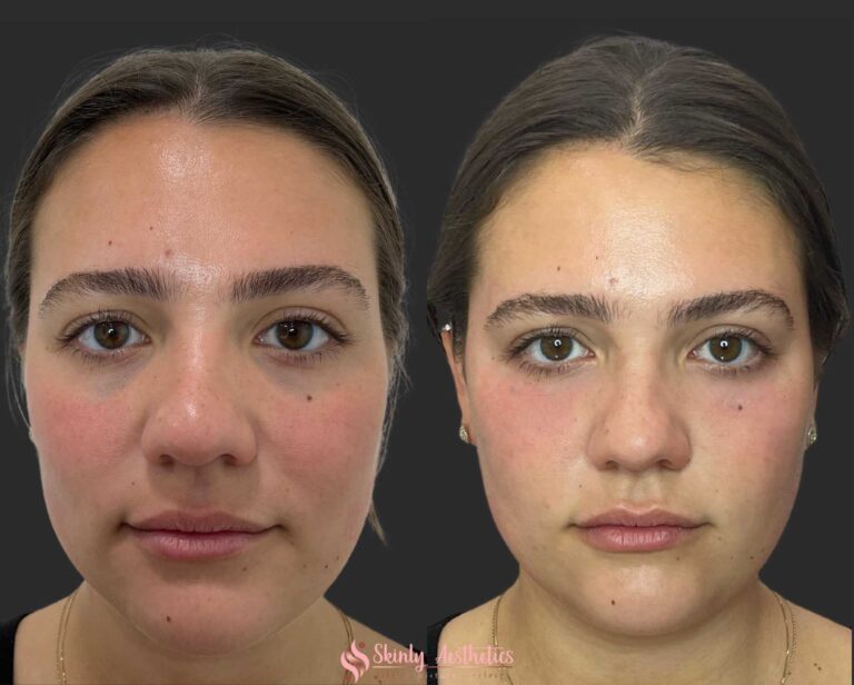 before and after results upon completion of dark under eye circle treatment with Restylane