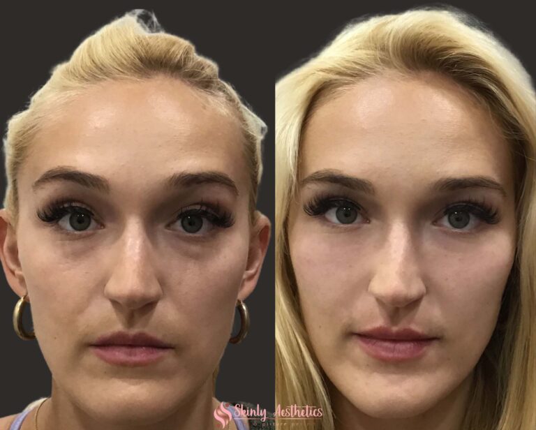 results following Restylane treatment for under eye circles