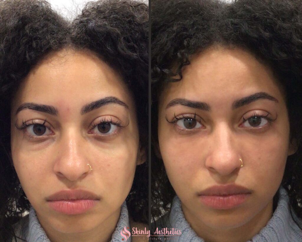 results after treatment of under eye dark circles with Juvederm hyaluronic acid filler
