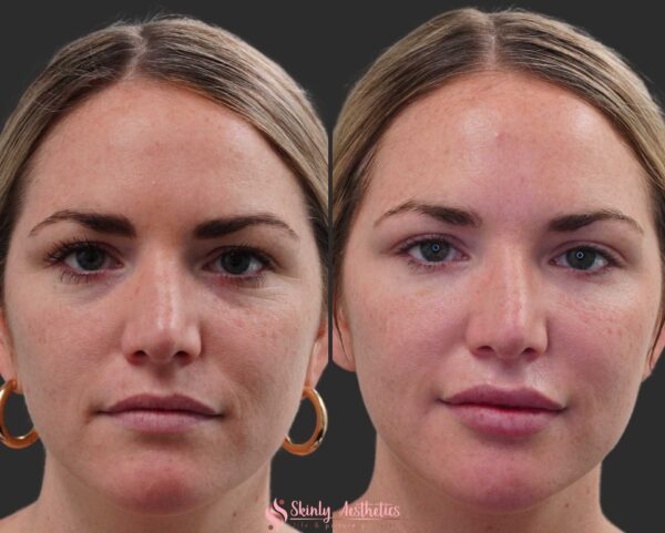 before and after of under eye hollow circles treated with Juvederm ultra filler