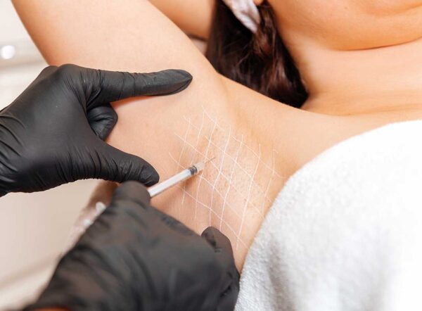 Botox injections for hyperhidrosis at Skinly Aesthetics