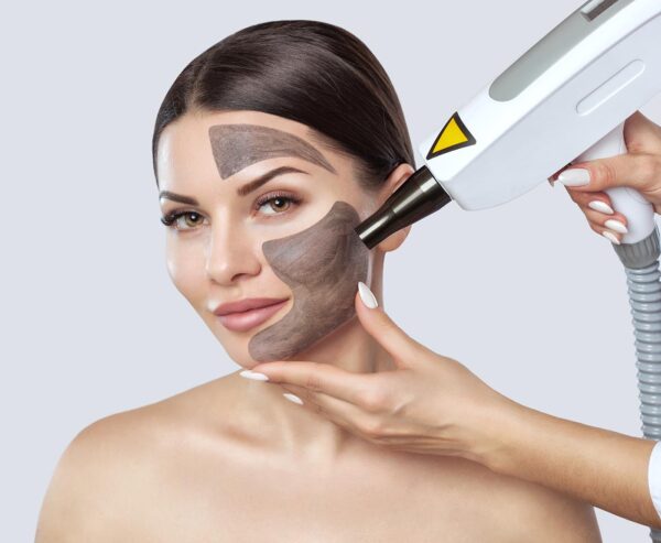 Carbon peel laser facial at Skinly Aesthetics