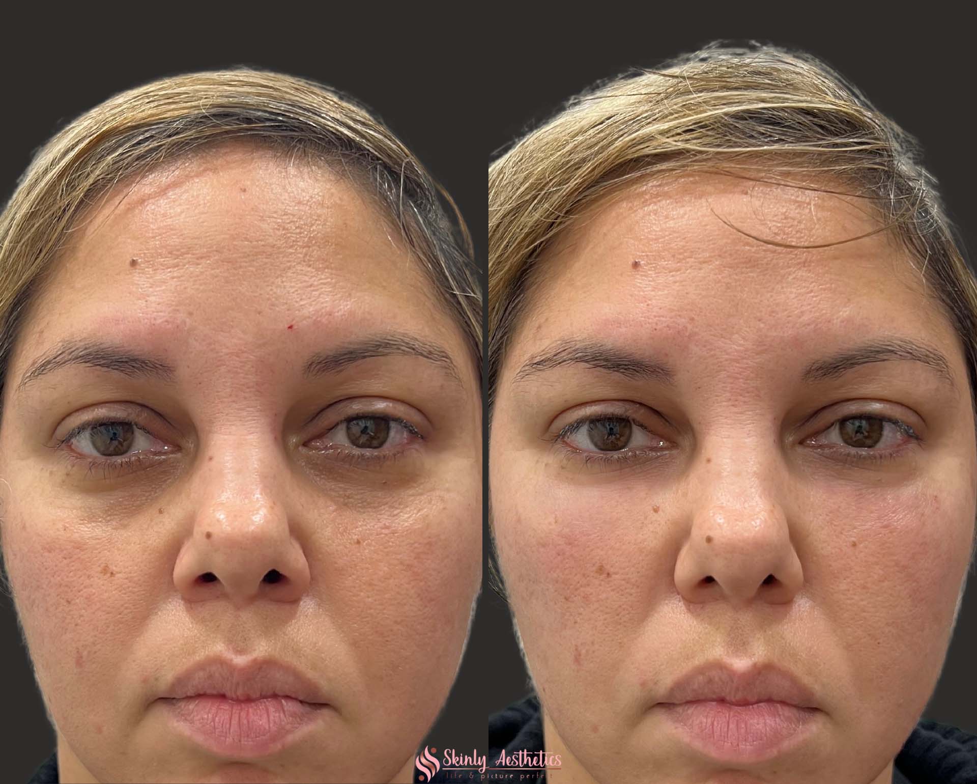 before and after results showing correction of deep under eye circles after injection with Restylane dermal filler
