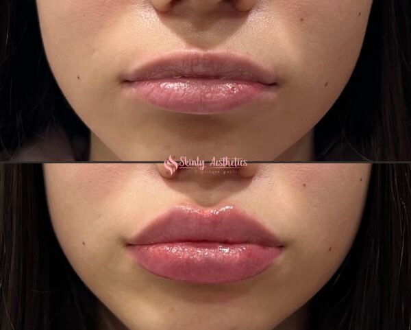 before and after results utilizing Russian lip technique following injection of 1.5ml of Juvederm Ultra filler