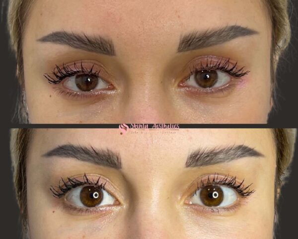 before and after results following Upneeq eye drops to open the eyes and lift upper eyelids