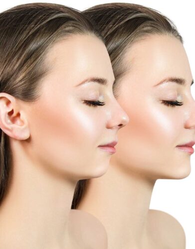 chin augmentation with filler at Skinly Aesthetics